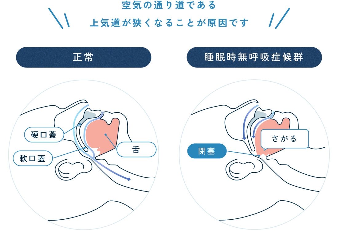 いびきと無呼吸のしくみ